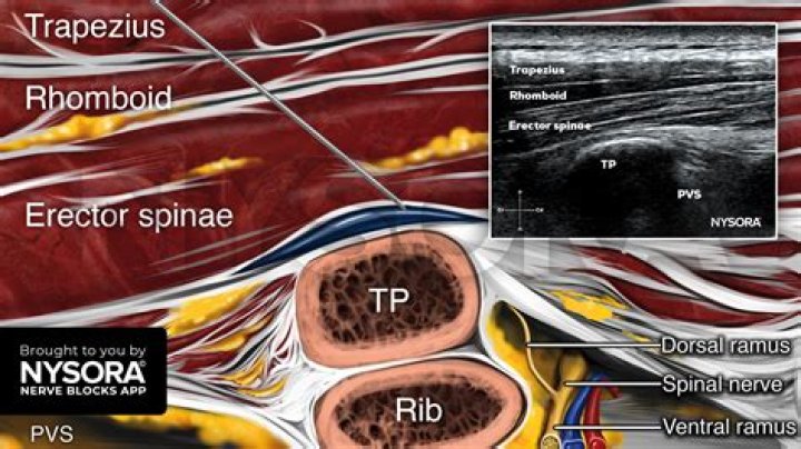 Who discovered erector spinae?
